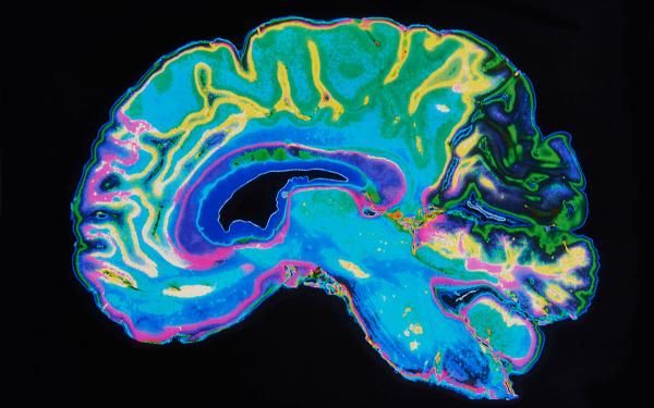 An MRI scan of a brain, illuminated in blue, green, yellow, and purple.