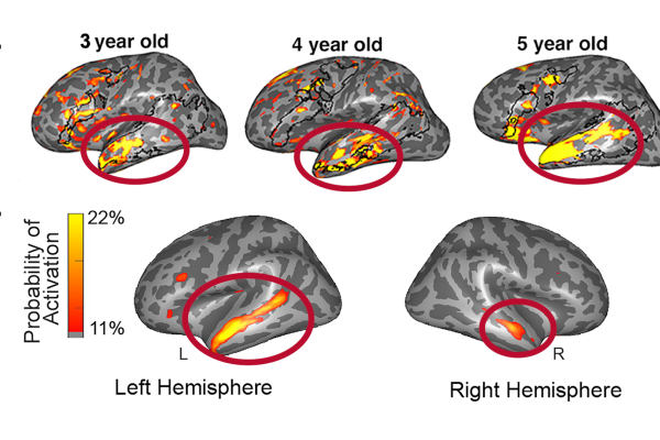 Five gray brain illustrations with portions of the lower right highlighted in yellow and red.