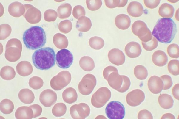 Chronic Lymphocytic Leukemia Cells in Blood Chronic Lymphocytic Leukemia Cells in Blood
